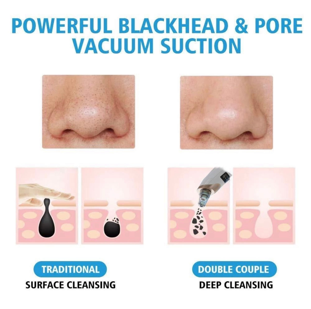 Briliant™ Portable Blackhead & Pore Cleaner